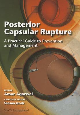 Posterior Capsular Rupture: A Practical Guide to Prevention and Management
